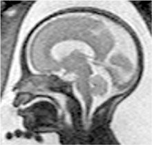 МРТ-изображение головного мозга плода. Белое пространство вокруг головы плода представляет собой амниотическую жидкость