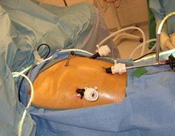 Лапароскопическая операция по имплантации стимулятора